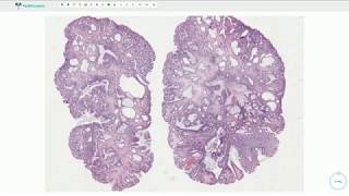 Juvenile polyp  Colon Histopathology [upl. by Owades554]