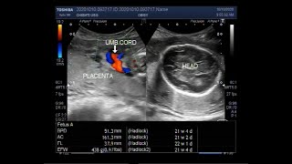 Ultrasound Video showing extreme of Oligohydromnios is Anhydramnios [upl. by Ginzburg]