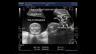 Anencephaly with Polyhydramnios in pregnancy of about 26 weeks [upl. by Carlstrom]