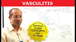 Vasculitis  An Overview [upl. by Eenerb477]