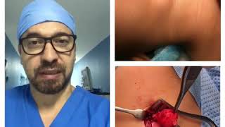 Preauricular Cyst Infection Management [upl. by Delp]