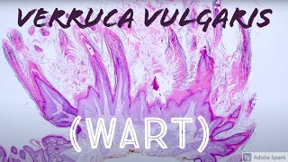 Wart Under the Microscope Verruca Vulgaris vs Seborrheic Keratosis Pathology [upl. by Myrle]