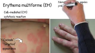 Erythema Multiform  Simply explained skin redness and rush pinkred ring around a pale center [upl. by Enilegnave]