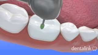 INCRUSTACIÓN dental  Video 3D paso a paso [upl. by Broddy709]