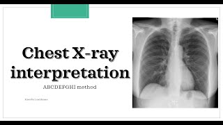 Chest Xray interpretation ABCDEFGHI method [upl. by Giffer]