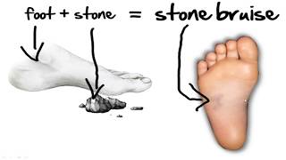 Stone Bruise Foot Pain HOME Treatment [upl. by Tahp]