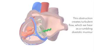 Mitral Stenosis  sound amp animation [upl. by Enileuqcaj244]