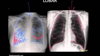 Pneumonia Imaging [upl. by Rotce569]