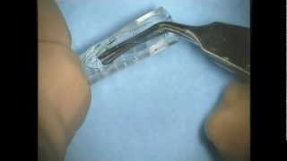 OPVideo Implantation einer torischen Visian ICL V4C [upl. by Dian]