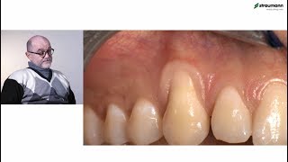 Prof Giovanni Zucchelli Treatment of class I gingival recession [upl. by Eruza948]