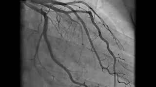 Coronary Angiography  NEJM [upl. by Maryjane]