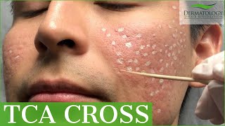 Acne Scar Removal with TCA Cross 80  Los Angeles  Dr Ben Behnam [upl. by Edva]