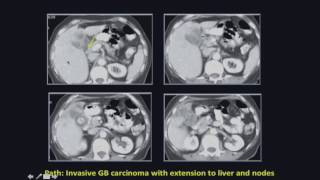 Ultrasound Video showing Gallbladder Wall Thickening [upl. by Lleneg]