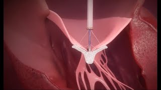 TEER Procedure with MitraClip Therapy [upl. by Joshia]