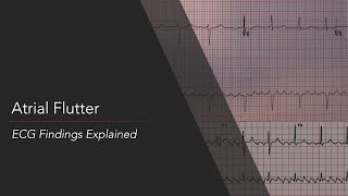 Atrial Flutter ECG Findings Explained [upl. by Ezeerb]