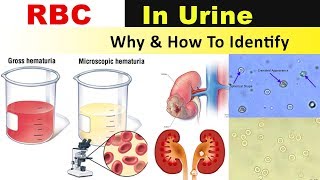 RBC In Urine  Why amp How to Identify [upl. by Eniamej]