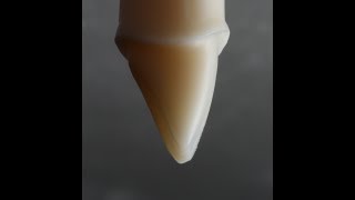 All Ceramic Crown Preparation for Emax and Zirconia [upl. by Anyr945]