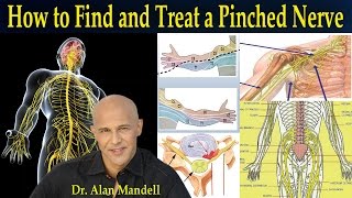 How To Find and Treat a Pinched Nerve Simple Neurology  Dr Mandell [upl. by Obellia440]