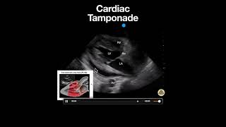 Cardiac Tamponade PSLA [upl. by Waine]