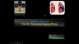 Ultrasound Case 44  Incarcerated Inguinal Hernia [upl. by Ylac]