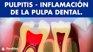 Pulpitis  Inflamación de la pulpa dental © [upl. by Anirdua]