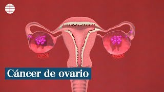 ¿Qué es el cáncer de ovario [upl. by Nortad]