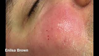 Christians Acne Treatment  Blackheads Extractions [upl. by Laekim749]