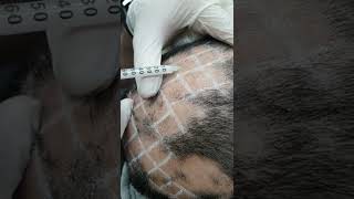 Demo19 Intralesional triamcinolone for alopecia areata [upl. by Gaynor]