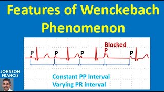 Features of Wenckebach Phenomenon [upl. by Blayne]