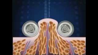 How Endermologie® works lipomassage [upl. by Lipkin]