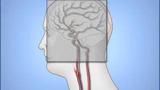 Coronary Angiogram Procedure [upl. by Dam]