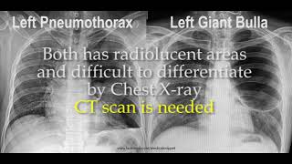 Pneumothorax vs Bulla in Chest X ray [upl. by Hoon]