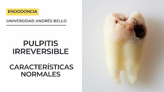 PULPITIS IRREVERSIBLE Características normales [upl. by Abroms]