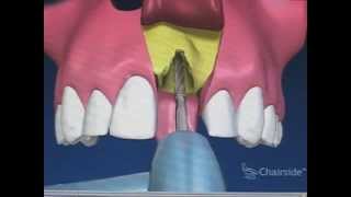 Implant with bone graft and membrane [upl. by Alphonso423]