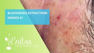 Blackheads Extractions Draven 7th Treatment [upl. by Ecenaj]