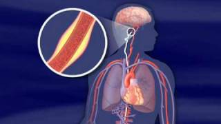 Extracranial Thrombectomy with eSAVE [upl. by Nohsauq655]