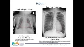 Approach to Pediatric Chest XRays [upl. by Eneryc]