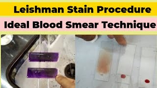 Leishman Stain Procedure and Blood Smear Preparation for DLC Count [upl. by Anahsed]