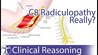 Ulnar Nerve Entrapment mimicking C8 Radiculopathy [upl. by Worrad]