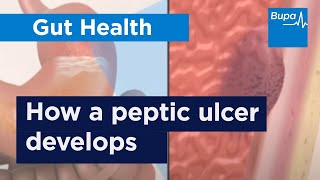 How a peptic ulcer develops  Bupa Health [upl. by Nnaecarg610]