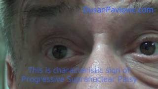 Progressive Supranuclear Palsy [upl. by Hach]