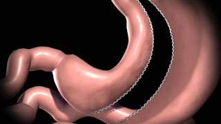 Realize Sleeve Gastrectomy Procedure Animation [upl. by Ariom27]