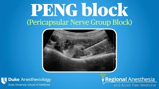 PENG Block Pericapsular Nerve Group Block [upl. by Dempsey583]