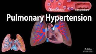 Pulmonary Hypertension Animation [upl. by Orat336]