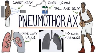 Pneumothorax [upl. by Maiga471]