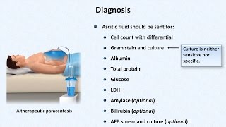 Spontaneous Bacterial Peritonitis [upl. by Aiclid66]