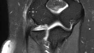 Common extensor tendon tear or elbow [upl. by Barnes]