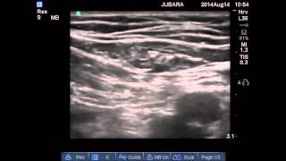 genitofemoral nerve block [upl. by Ayian]