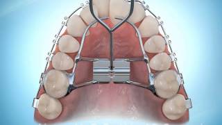 Hyrax Rapid Palatal Expansion Braces During [upl. by Drofliw297]