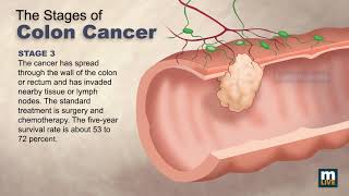 Surgeon Simply Explains Colon Cancer Surgery [upl. by Dopp38]